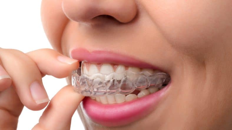 Invisalign